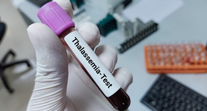 شادی اور تھلیسیمیا ٹیسٹ لازم و ملزوم کیوں؟ 1 شادی اور تھلیسیمیا ٹیسٹ لازم و ملزوم کیوں؟