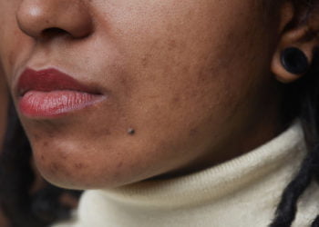 Embracing Imperfections: How to Overcome Your Skin Insecurities